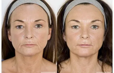 Before and after lines and wrinkles treatment