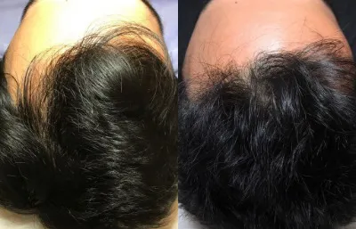 Before and after PRP hair rejuvenation treatment