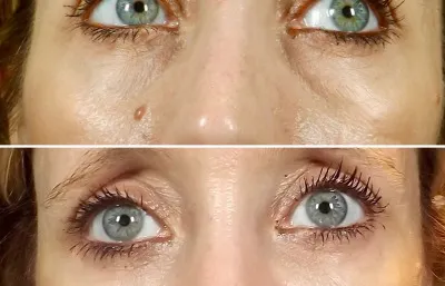 Before and after Tear trough filler treatment