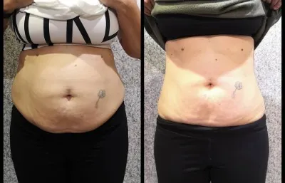 Before and after 3Dlipo fat freezing treatment