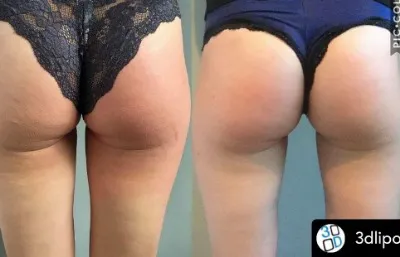 Before and after image of a bum lift using 3D lipo