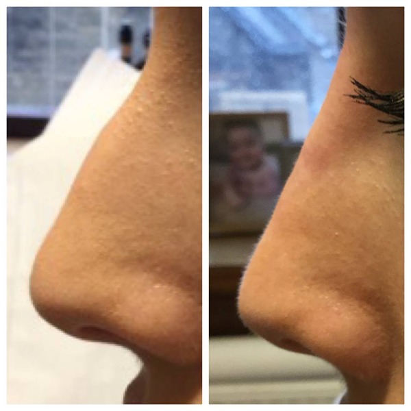 Non-Surgical Nose Job Before and Immediately After