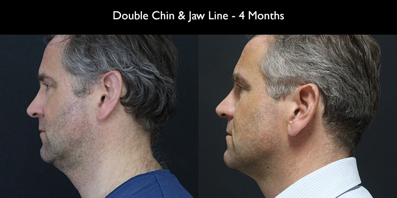 Reduction of double chin and jowls