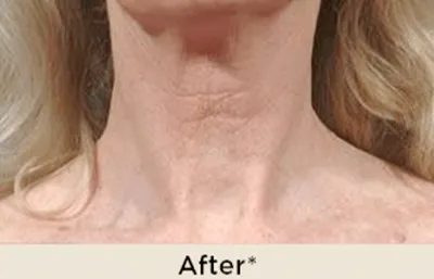 After Fraxel Treatment