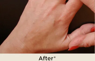 After Hand Rejuvenation Treatment