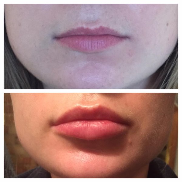 1.5ml filler