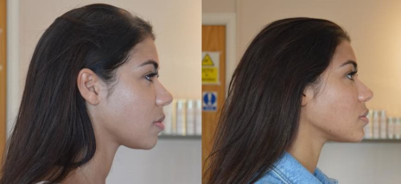 Jawline - Dermal filler to create a sharper edge and reshape chin