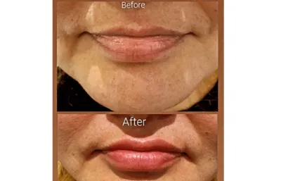 Before and after lip rejuvenation treatment