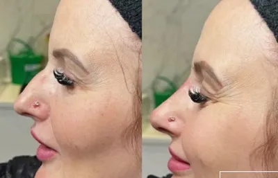 Before and after nose rejuvenation treatment