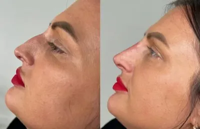 Before and after nose reshaping treatment