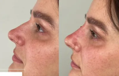 Nose reshaping treatment Before and after
