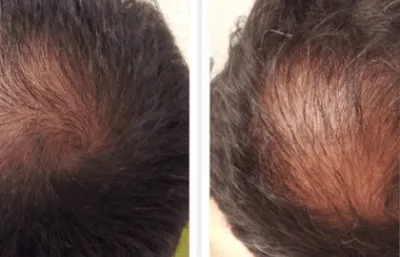 Before and after Hair loss treatment