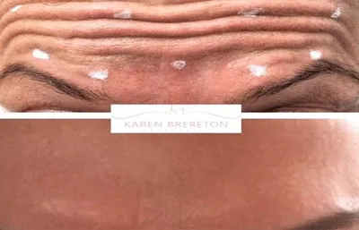 Before and after lines and wrinkles treatment