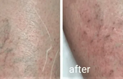 Before and after vein treatment