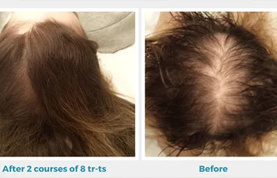 hair loss treatment before and after