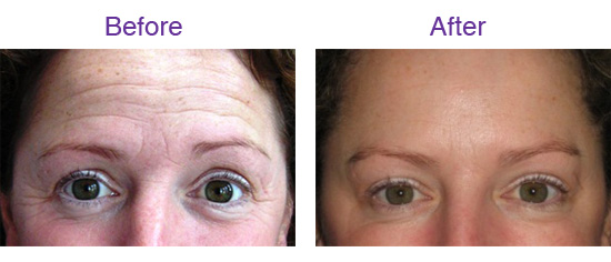 Before & After 'Botox' Treatment in the forehead Photo