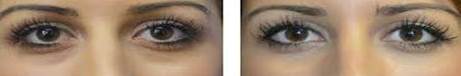 Before & After Tear Trough