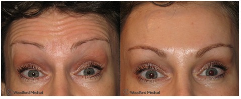 Before and after Botox