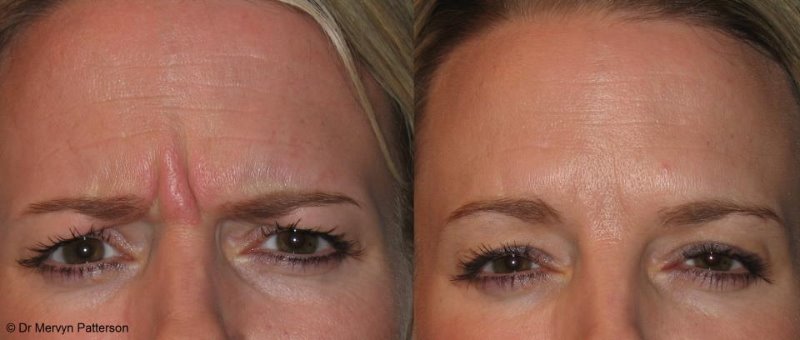 Before and After Botox