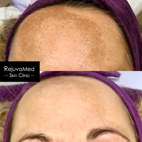 DermaNeedling Results