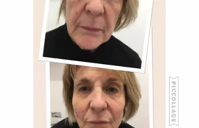 Before and after Radiesse dermal filler. treatment