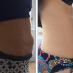 Fat Freezing before and after