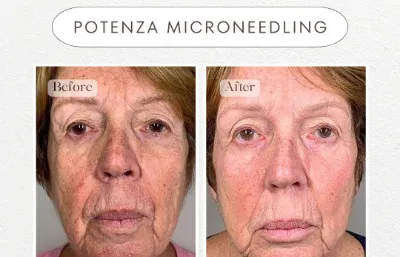 Before and after medical skin needling treatment
