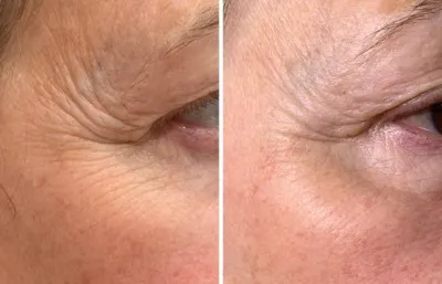 Before and after microneedling treatment
