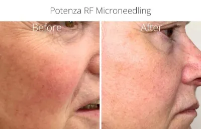 Before and after Potenza RF microneedling treatment