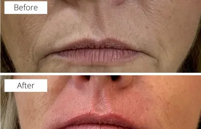 Before and after Dermal filler treatment