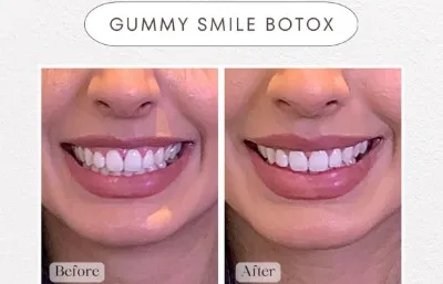 Before and after Gummy smile treatment