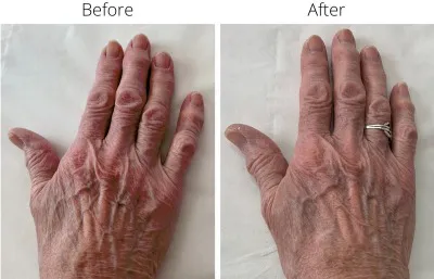 Before and after hand rejuvenation treatment