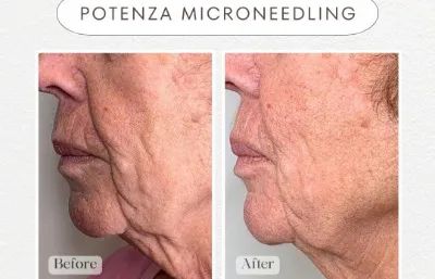 Before and after Micro-needling treatment
