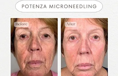 Micro-needling treatment before and after