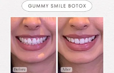 Before and after gummy smile treatment