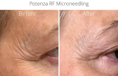 Before and after medical skin needling treatment