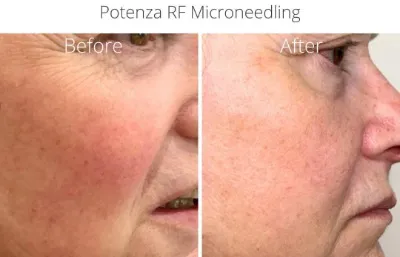 Before and after Potenza RF microneedling