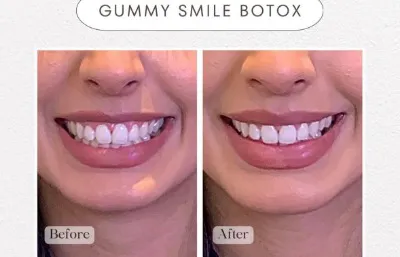 Before and after gummy smile treatment