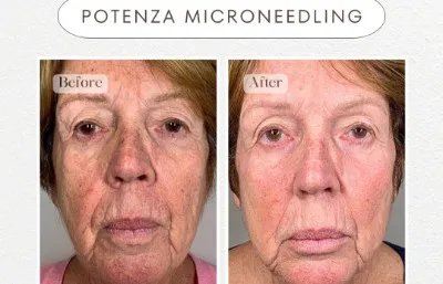 Before and after medical skin needling treatment