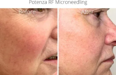 Before and after Potenza RF microneedling treatment