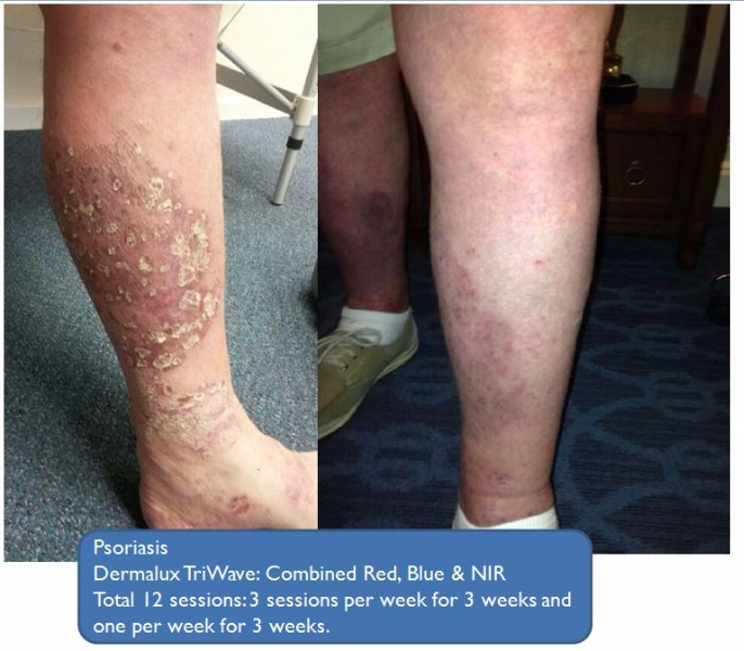 Psoriasis Before and After