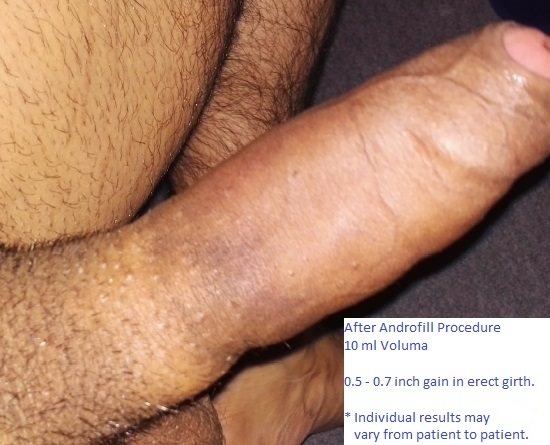 Patient B (E) After