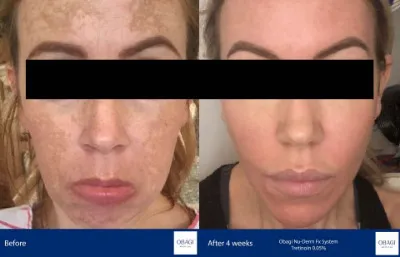 Before and after Obagi Nu-Derm