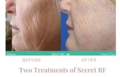 Before and after Secret RF treatment