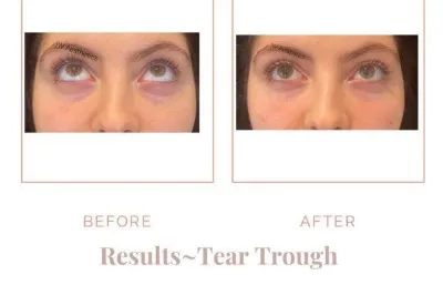 Before and after Tear trough treatment