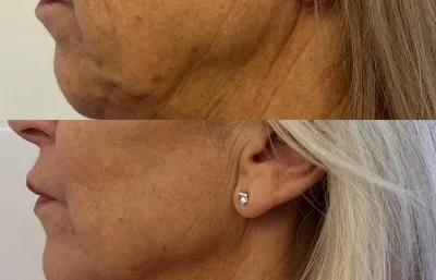 Before and after facial skin tightening treatment