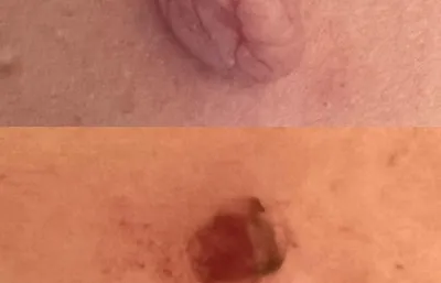 Before and after Mole removal treatment