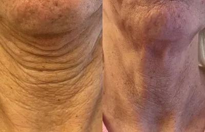 Before and after neck rejuvination treatment