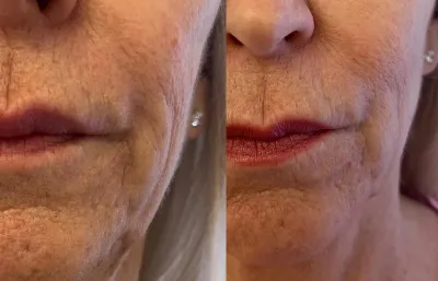 Before and after skin rejuvenation treatment
