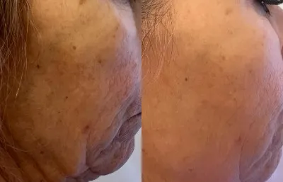 skin rejuvenation before and after treatment